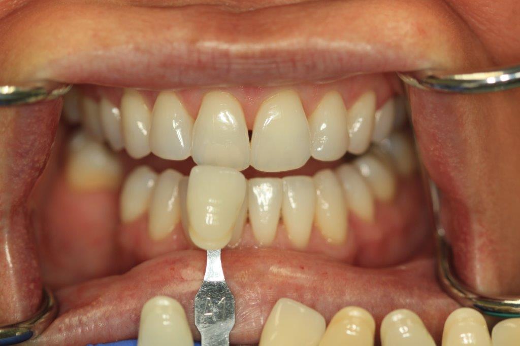 Glo-Teeth-Whitening-before
