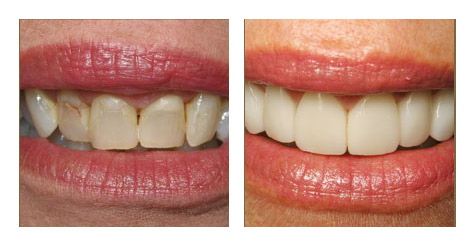 Are Veneers Right for Your Teeth?