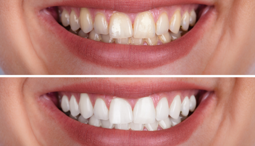 teeth whitening south charlotte