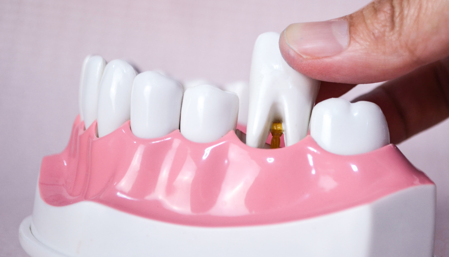 wisdom tooth extraction south charlotte