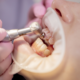 what is icon dental treatment