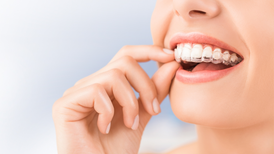 How to Clean Invisalign Retainers