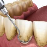 what is periodontal therapy