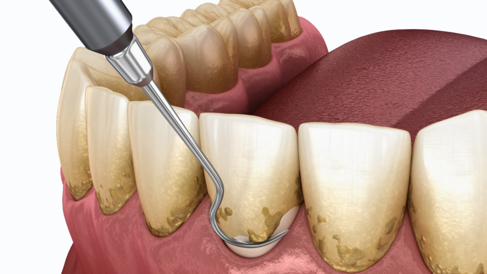 what is periodontal therapy