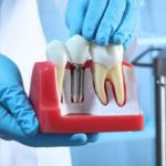 how do dental implants work