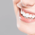 Can You Whiten Teeth After Icon Treatment