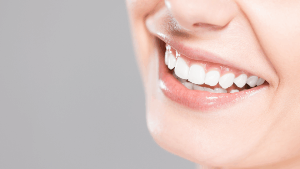 Can You Whiten Teeth After Icon Treatment