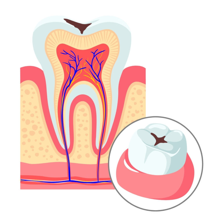 The 5 Stages of Tooth Decay & How to Stop It Early | Cedar Walk Dentistry