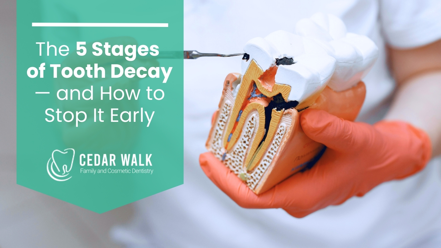 Remove Tooth Decay The 5 Stages of Tooth Decay & How to Stop It Early | Cedar Walk Dentistry